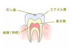 C0　ごく初期のむし歯