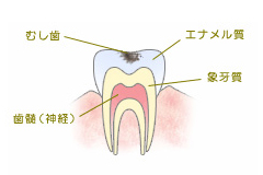 C1　エナメル質のむし歯