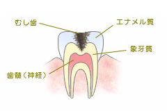 C2　象牙質のむし歯