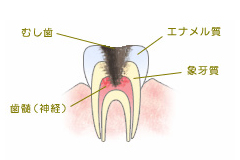 C3　神経に達したむし歯