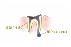 C4　歯の根に達したむし歯