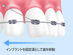 歯を抜かない治療～インプラント矯正～
