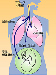 歯周病の影響